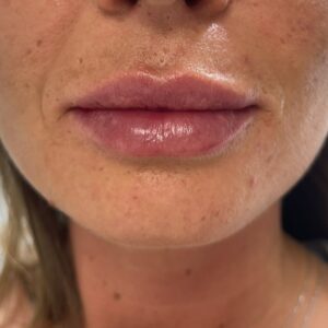 Lippenunterspritzung Russian Lips danach