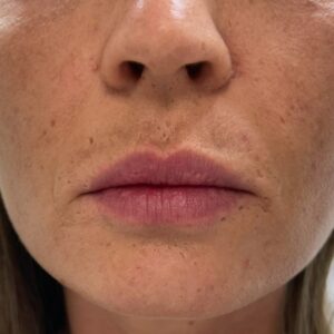 Lippenunterspritzung Russian Lips davor