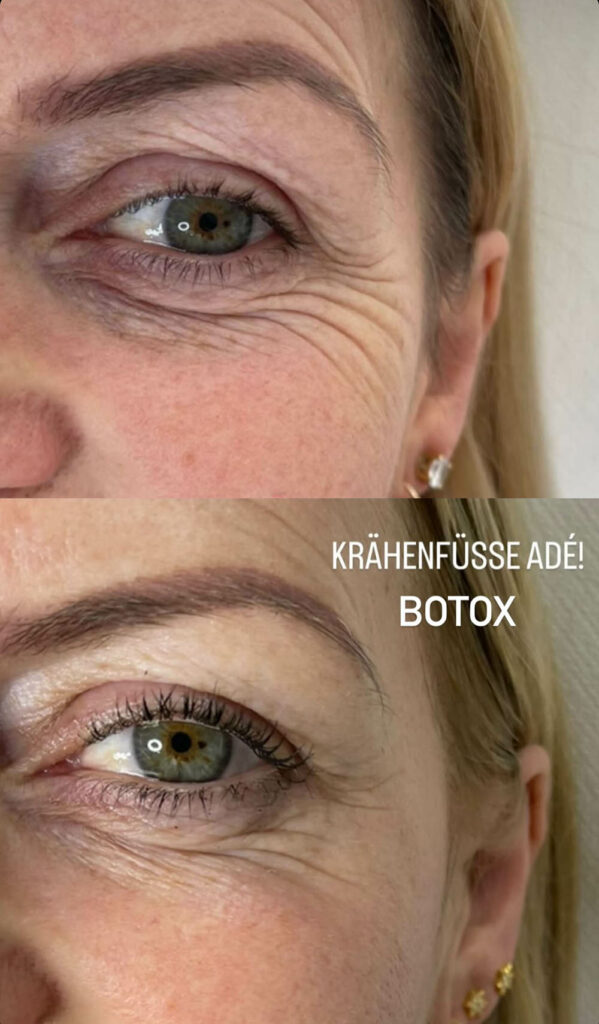 Botox gegen Krähenfüße