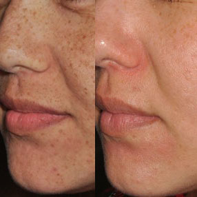 IPL Behandlung vorher - nachher