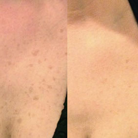 IPL Behandlung vorher - nachher