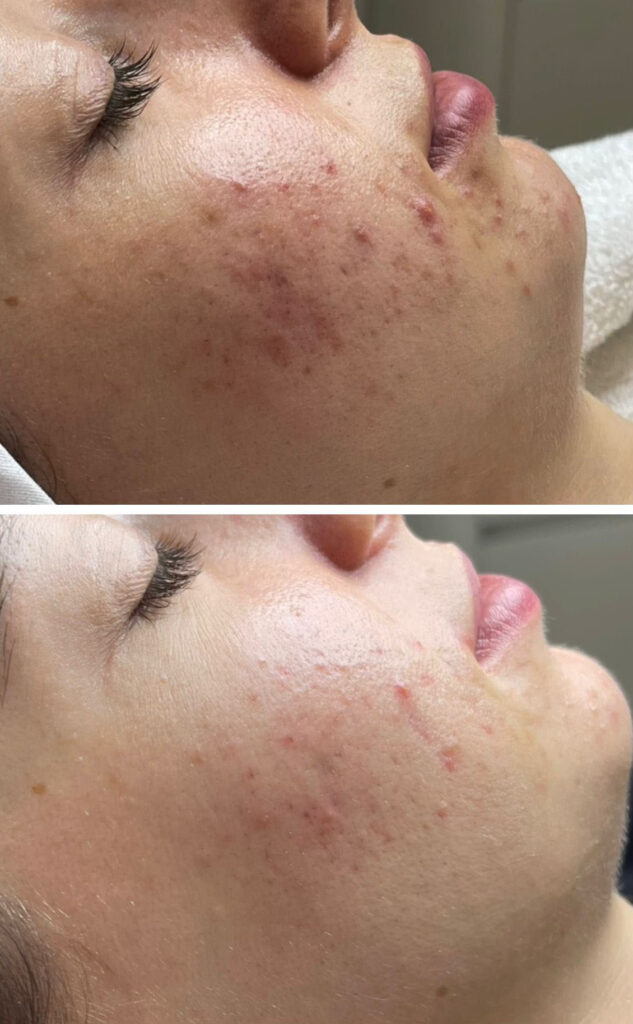 Gesichtsreinigung Vorher/Nachher