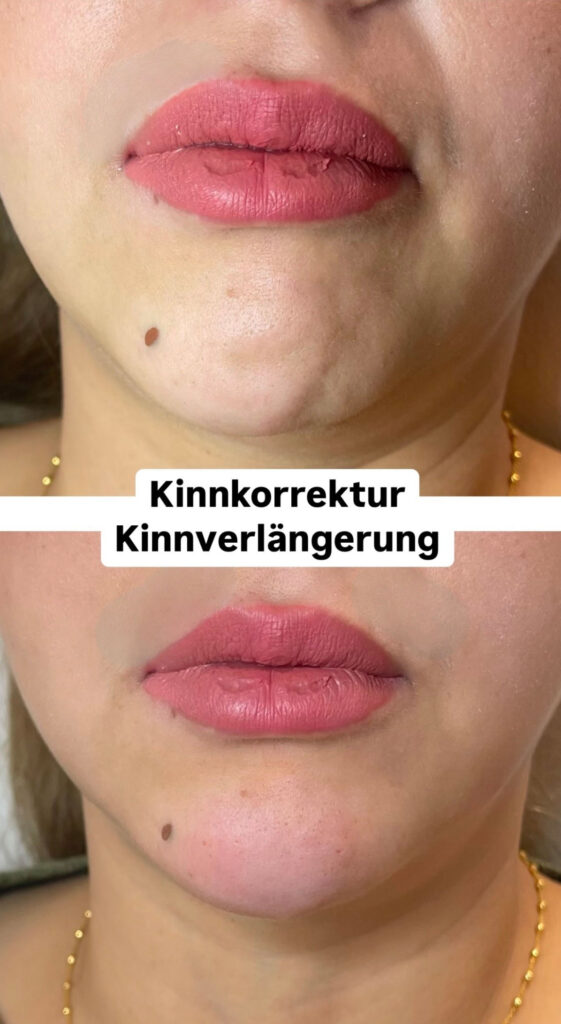 Kinn unterspritzen - Vorher / nachher