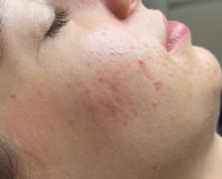 Gesichtsreinigung Akne